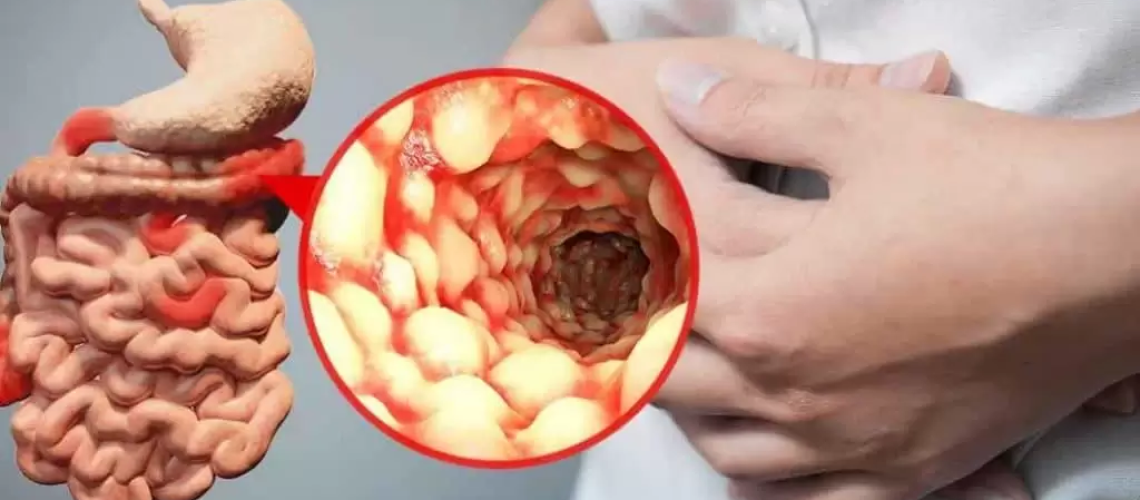 دکتر التهاب روده در کرج