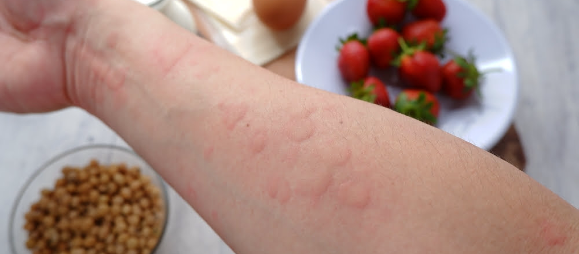 دکتر آلرژی غذایی در شیراز